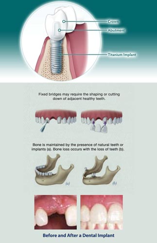 How-do-dental-implants-work-tile